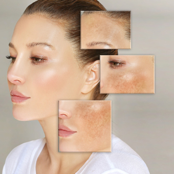 הבהרת כתמי פיגמנטציה